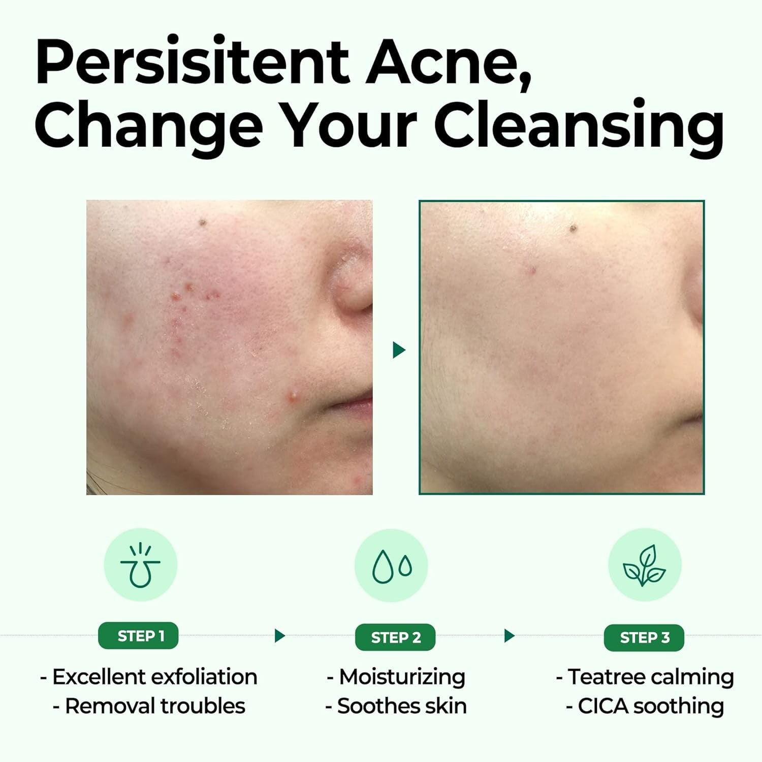 AHA, BHA, PHA 30 Days Miracle Cleansing Bar (1pc)
