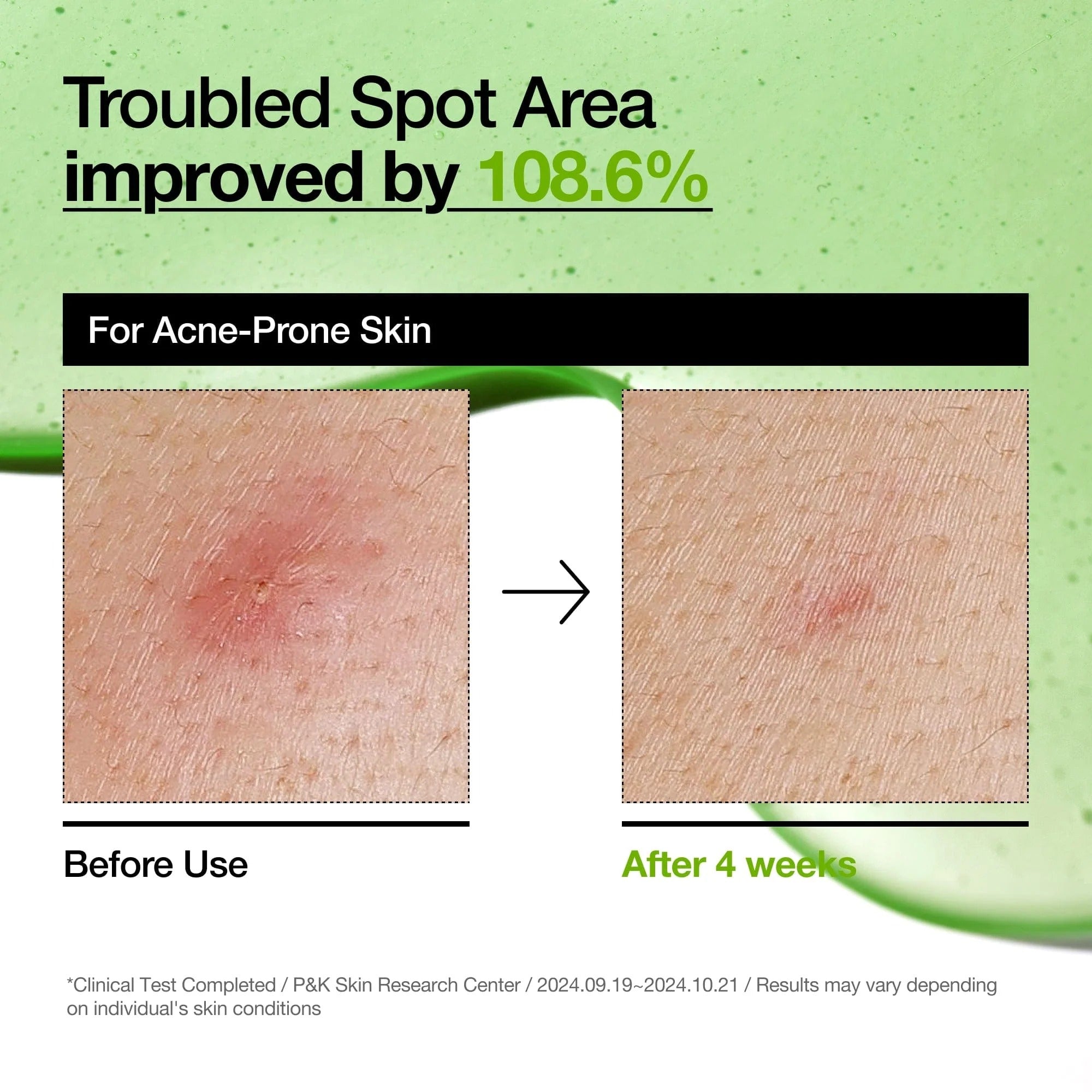 Azelaic Acid 10 Hyaluron Redness Soothing Serum (30ml)