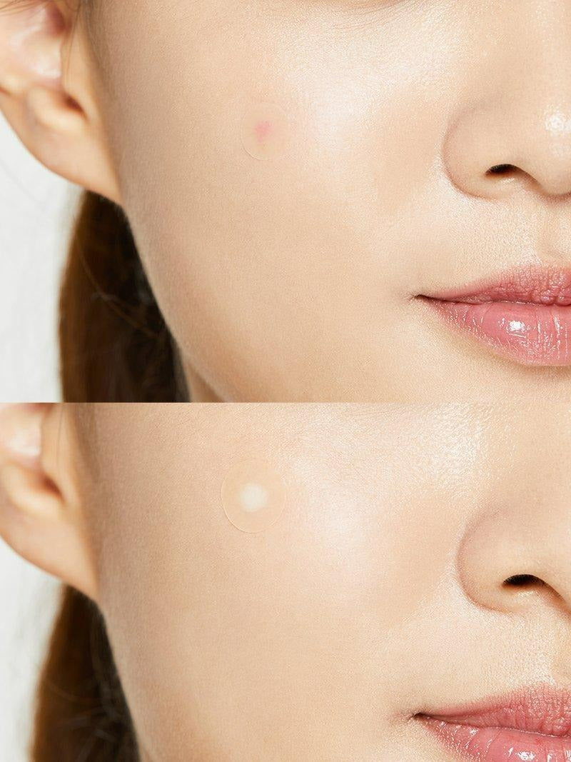 Acne Pimple Master Patch (1sheet)